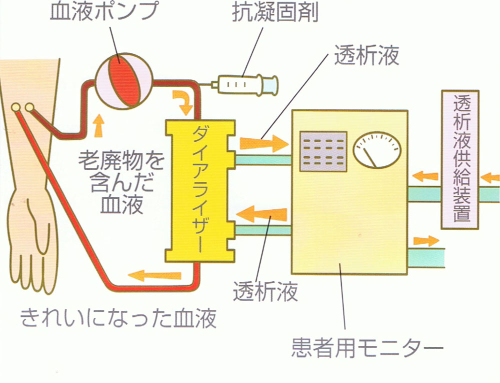 血液透析のイメージ