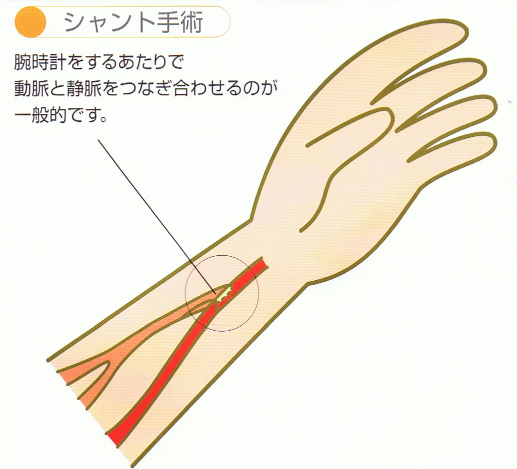 シャント手術のイメージ