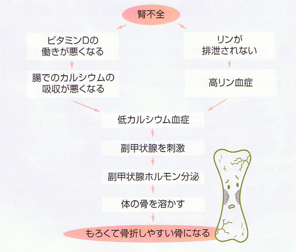 二次性副甲状腺機能亢進症の発症メカニズムを示すフローチャート。腎不全によるビタミンD不活性化とリン蓄積が低カルシウム血症を招き、それにより副甲状腺が刺激され過剰にホルモンを分泌、結果として骨が溶かされる様子が示されている
