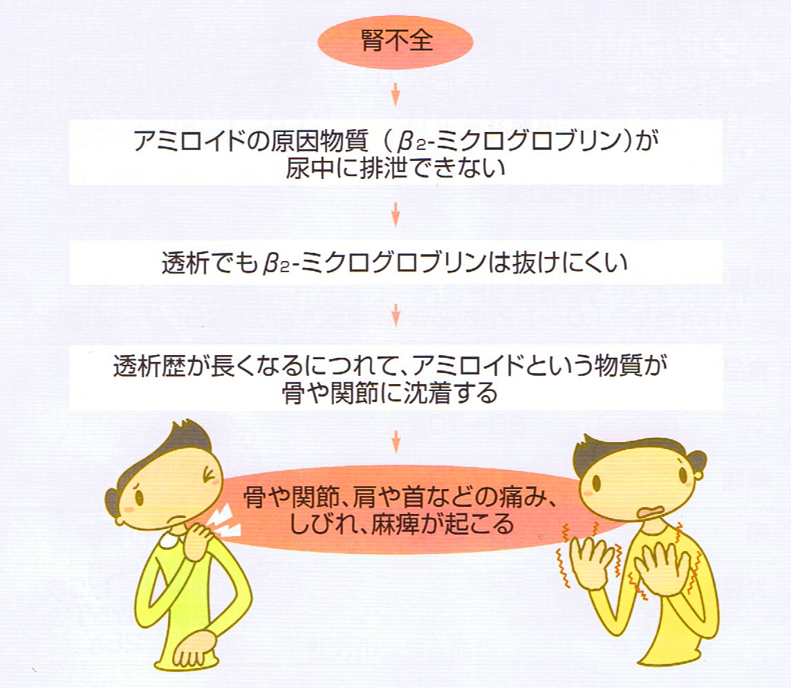アミロイド骨関節症の発症メカニズムを示すフローチャート。腎不全によりアミロイドの原因物質であるβ2-ミクログロブリンが尿中に排泄されず、透析でも抜けにくいため、透析歴が長くなるにつれてこの物質が骨や関節に沈着し、痛み、しびれ、麻痺が起こる様子が示されている。